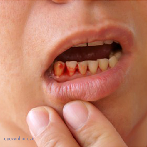 Dấu hiệu bệnh từ sức khỏe răng miệng